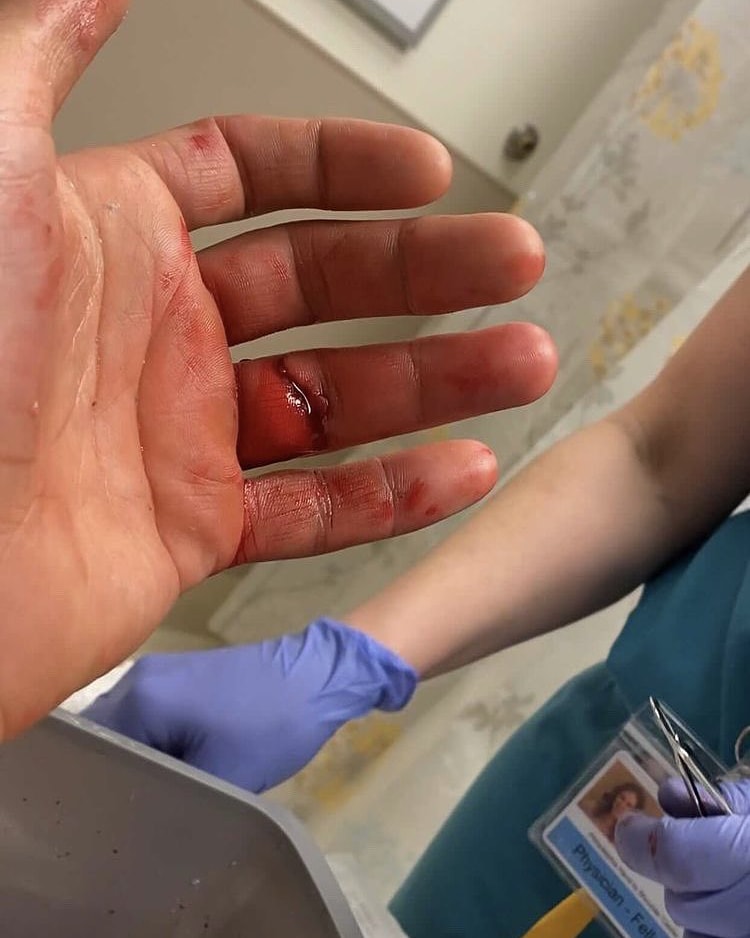 MMA fighter Khetag Pliev from Ossetia fought a whole round with a severed finger.